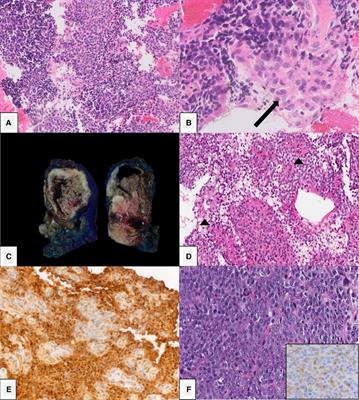 Solid pancreatic masses in children: A review of current evidence and clinical challenges